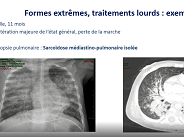 Particularité de la prise en charge chez l'enfant