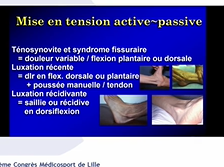 Pathologies des fibulaires Pathologies des fibulaires