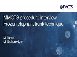 Pathologies vasculaires - La technique de la "Trompe d'éléphant gelée" Pathologies vasculaires - La technique de la "Trompe d'éléphant gelée"