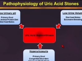 Physiopathologie et la gestion des pierres d'acide urique