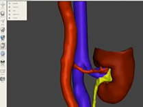 Patient specific rehearsal using 3D printing for complex partial nephrectomy cases Patient specific rehearsal using 3D printing for complex partial nephrectomy cases