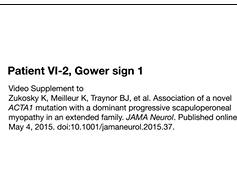 Patient VI-2, Gower sign 1 Patient VI-2, Gower sign 1