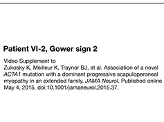 Patient VI-2, Gower sign 2 Patient VI-2, Gower sign 2