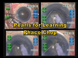 Pearls for Learning Phaco Chop Pearls for Learning Phaco Chop