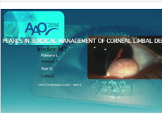 Pearls in Surgical Management of Corneal Limbal Dermoids Pearls in Surgical Management of Corneal Limbal Dermoids