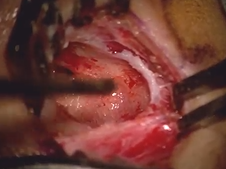 Pediatric cochlear implantation (6 months of age)