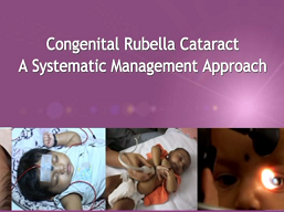 Ophtalmologie pédiatrique, Strabisme - Cataracte congénitale de la rubéole : Une gestion d'approche systématique Ophtalmologie pédiatrique, Strabisme - Cataracte congénitale de la rubéole : Une gestion d'approche systématique