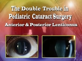 Ophtalmologie pédiatrique, Strabisme - Difficultés doubles pour la chirurgie pédiatrique de la cataracte Ophtalmologie pédiatrique, Strabisme - Difficultés doubles pour la chirurgie pédiatrique de la cataracte