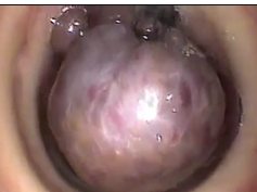 Pedunculated Tracheal Mass