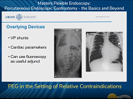 PEG in the Setting of Relative Contraindications