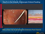 PEG-J: How I Do It (and Keep the Extension Post-Pyloric!)