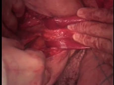 Pelvic Floor Reconstruction with Bilateral Gracilis Flaps After Extralevator APE Pelvic Floor Reconstruction with Bilateral Gracilis Flaps After Extralevator APE