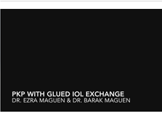 Penetrating Keratoplasty and IOL Exchange Using the Glued-on Lens Technique Penetrating Keratoplasty and IOL Exchange Using the Glued-on Lens Technique