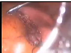 Per Oral Stapler Rescue