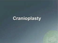Performing a Cranioplasty