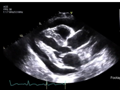 Pericardial Tamponade From a Fractured Inferior Vena Cava (IVC) Stent