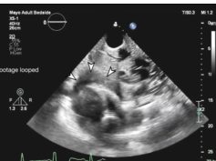 Pericardial Tamponade With Echo Contrast Confirmation of Pericardial Catheter Placement Pericardial Tamponade With Echo Contrast Confirmation of Pericardial Catheter Placement
