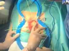 Perineal approach for the excision of an ischiorectal lipoma. A video vignette. Perineal approach for the excision of an ischiorectal lipoma. A video vignette.