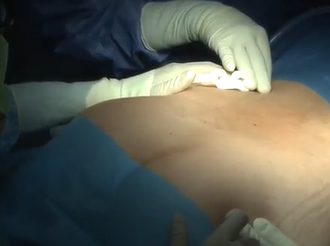 Perineal lipofilling after an extralevator abdominoperineal excision