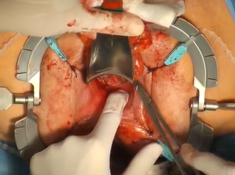 Perineal Rectosigmoidectomy (Altemeier´s procedure) for Full-thickness Rectal Prolapse Perineal Rectosigmoidectomy (Altemeier´s procedure) for Full-thickness Rectal Prolapse