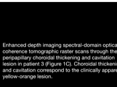 Peripapillary Choroidal Thickening and Cavitation Peripapillary Choroidal Thickening and Cavitation
