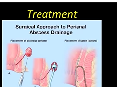 Perirectal Abscess