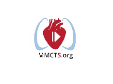 Perventricular device closure of a doubly committed subarterial ventricular septal defect Perventricular device closure of a doubly committed subarterial ventricular septal defect
