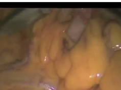 Pfannestiel Single Incision Laproscopic Proctocolectomy With Ilieal Pouch Anal Anastomisis And Diver Pfannestiel Single Incision Laproscopic Proctocolectomy With Ilieal Pouch Anal Anastomisis And Diver