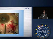 Phacoemulsification, PPV and Metallic Intraocular Foreign Body