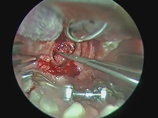 Pharyngeal Flap for Velopharyngeal Insufficiency