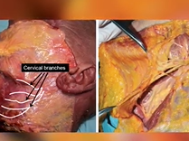 Plastic Surgery Holy Grail for Turkey Neck Plastic Surgery Hot Topics with Rod J. Rohrich, MD Plastic Surgery Holy Grail for Turkey Neck Plastic Surgery Hot Topics with Rod J. Rohrich, MD