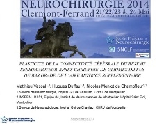 Plasticité de la connectivité cérébrale du réseau sensorimoteur après chirurgie de gliomes diffus de bas grade de l'aire motrice supplémentaire