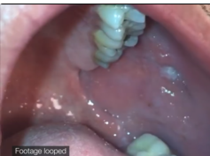Pneumoparotid With Frothy Saliva