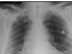 Pneumoperitoneum - Chest x-ray Pneumoperitoneum - Chest x-ray