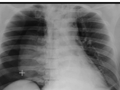 Pneumothorax --Tension Pneumothroax - Supine Pneumothroax Pneumothorax --Tension Pneumothroax - Supine Pneumothroax