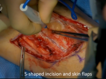 Popliteal Adventitial Cystic Disease Popliteal Adventitial Cystic Disease
