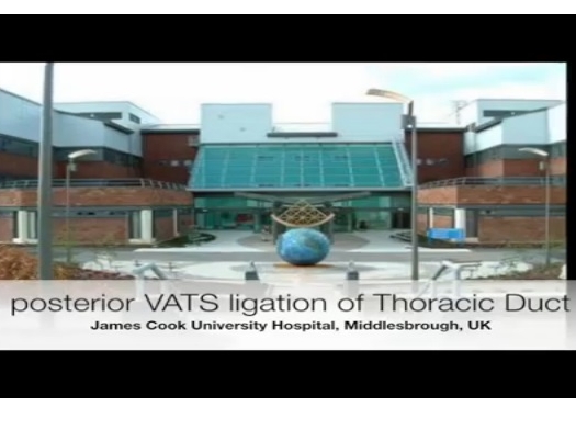 postérieure VATS ligature du canal thoracique