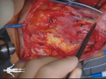 Posterior Approach Right Popliteal Artery Aneurysm Repair LoneStar Retractor Posterior Approach Right Popliteal Artery Aneurysm Repair LoneStar Retractor