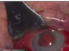 Posterior Chamber Intraocular Lens Suturing and Anterior Chamber Intraocular Lens Removal Posterior Chamber Intraocular Lens Suturing and Anterior Chamber Intraocular Lens Removal