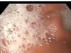 Pre-pyloric Hyperplastic Polup