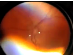 Predictive Value of Pre-plus Disease in Retinopathy of Prematurity Part 1 Predictive Value of Pre-plus Disease in Retinopathy of Prematurity Part 1