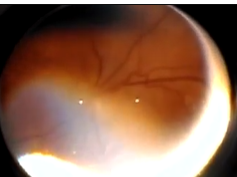 Predictive Value of Pre-plus Disease in Retinopathy of Prematurity Part 2 Predictive Value of Pre-plus Disease in Retinopathy of Prematurity Part 2