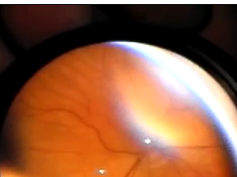 Predictive Value of Pre-plus Disease in Retinopathy of Prematurity Part 3 Predictive Value of Pre-plus Disease in Retinopathy of Prematurity Part 3