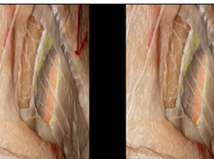 Preserving the Frontalis Muscle (3D TV)