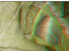 Preserving the Frontalis Muscle (Anaglyph 3D)