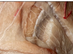 Preserving the Frontalis Muscle