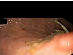 Prior Cyst Gastrostomy