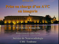 Prise en charge dun Accident vasculaire cérébral