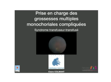 Prise en charge des grossesses multiples monochoriales compliquées Prise en charge des grossesses multiples monochoriales compliquées