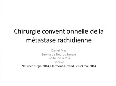 Prise en charge des métastases rachidiennes (2/5) - Chirurgie conventionnelle